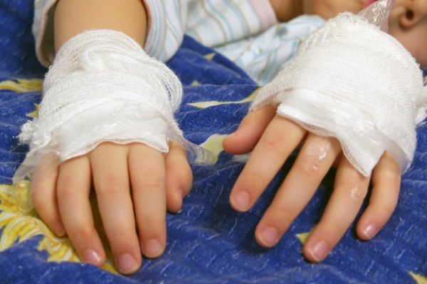 5-річна дитина з Львівської області отримала опіки через новорічну ялинку